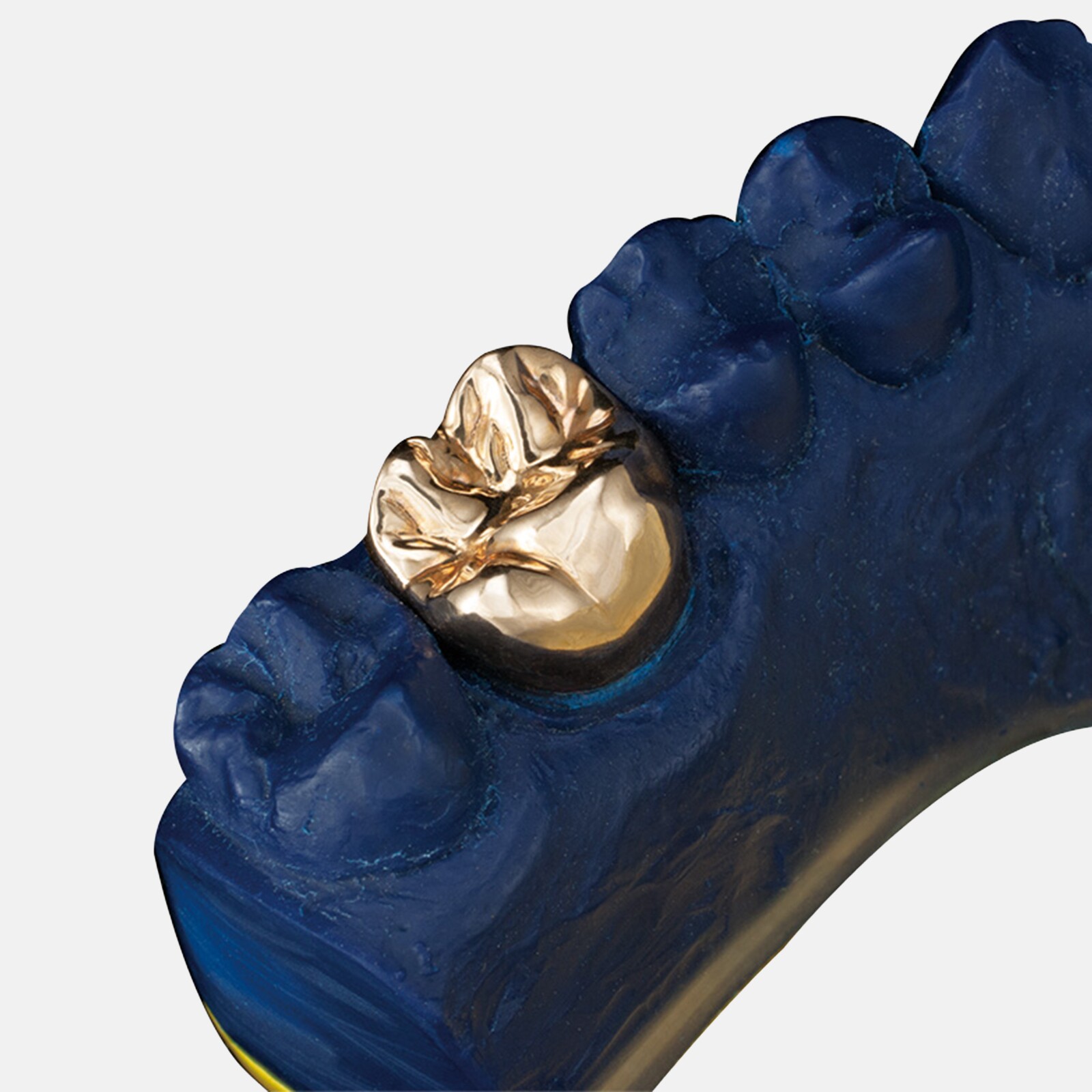 Qu’est-ce qu’une couronne en métal coulée ?